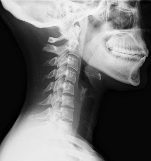 whiplash injury x-ray view